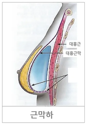 근막하 보형물 삽입 위치 단면 도해: 대흉근막 아래에 보형물 삽입