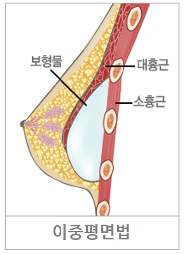 이중평면법(듀얼플레인) 보형물 삽입 위치 단면 도해: 대흉근과 유선 사이 이중 평면