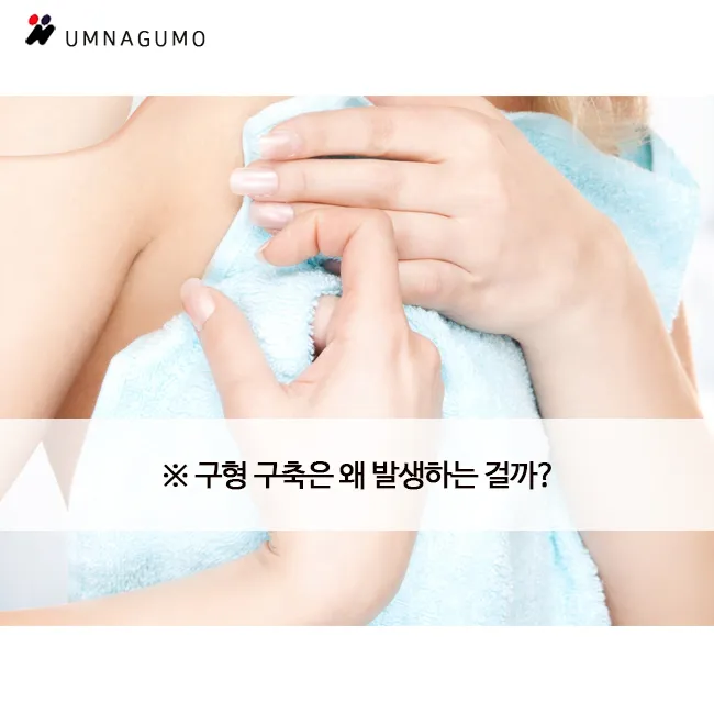 엄나구모성형외과 질문있어요!!::구형구축 궁금해요!! 안내 이미지