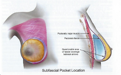 筋膜下（Subfascial）インプラントポケット位置の解剖図 — 大胸筋と大胸筋膜の表記