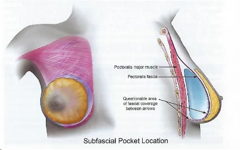 근막하(Subfascial) 보형물 포켓 위치 해부도: 대흉근과 대흉근막 표기