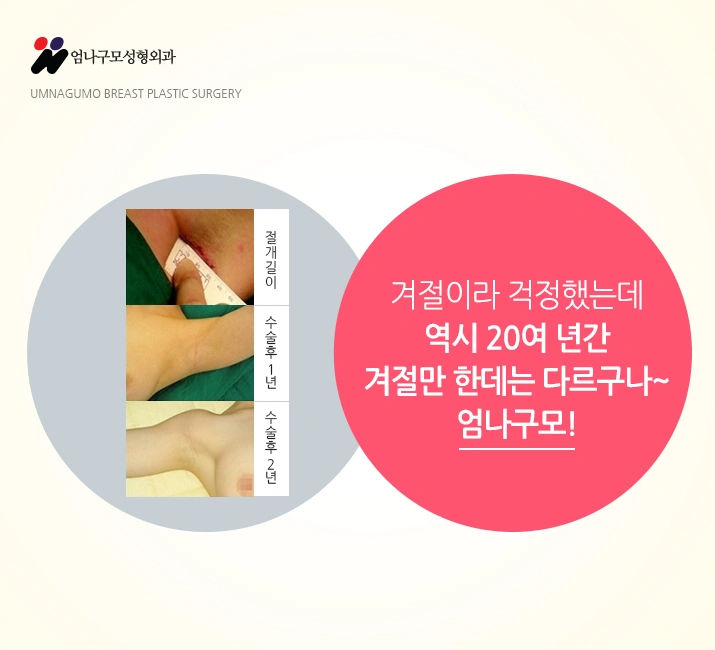 엄나구모 정보글::가슴수술 하고 운동 너무 하고 싶다고요? 안내 이미지