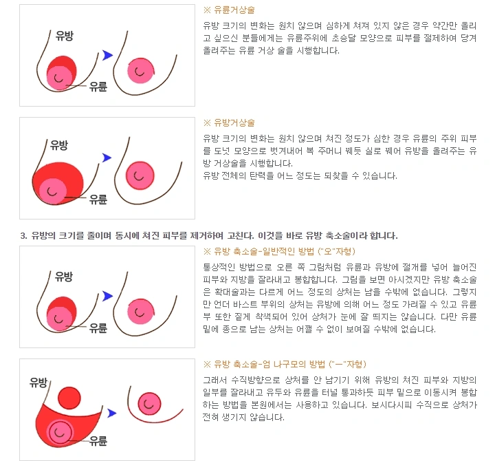 엄나구모 성형외과 도와줘요!! 가슴이 처져요ㅠㅠ 안내 이미지