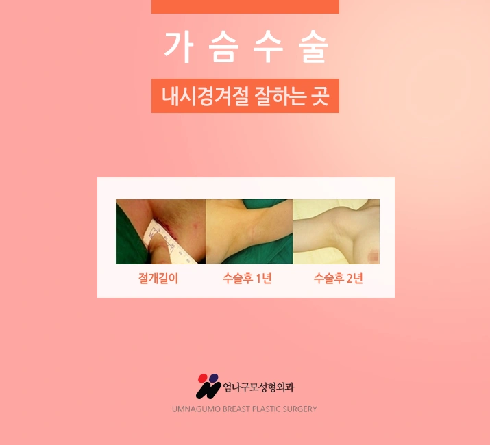 엄나구모 정보 글>>> 모티바 가슴성형 관심있는 분이신가요? 안내 이미지