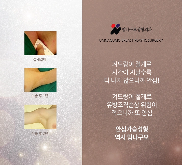 엄나구모정보글>>> 가슴성형수술전 주의사항 안내 이미지
