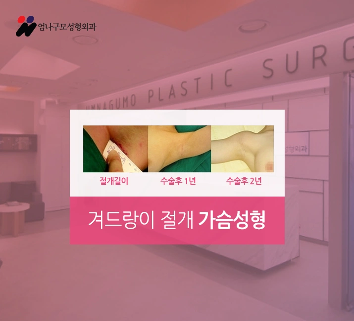 ※엄나구모 정보글※ 가슴성형 체형에 잘 맞는 풍만함~~ 안내 이미지