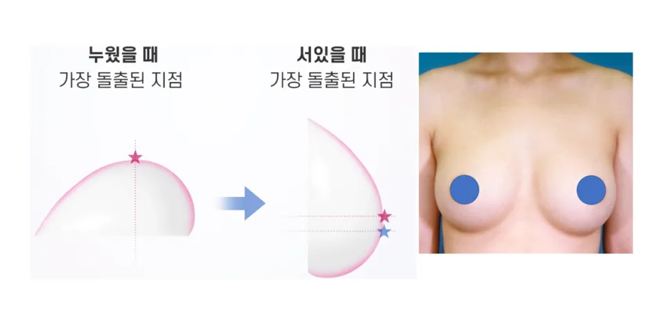 누웠을 때와 서 있을 때 보형물 최대 돌출 지점 변화 일러스트와 가슴성형 임상 사진