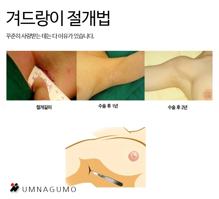 엄나구모성형외과 궁금해요 가슴확대수술 계절이 중요할까요?? 안내 이미지