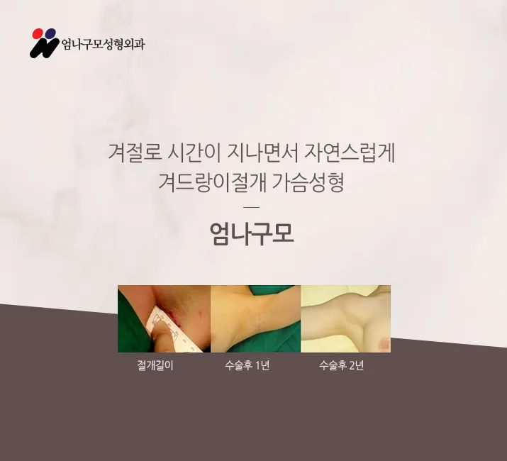 가치있는 가슴성형 엄나구모 모티바가슴성형 안내 이미지
