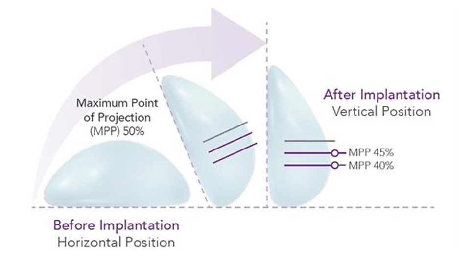 モティバインプラントのMPP（最大突出点）図解 — 挿入前の水平位置50%から挿入後の垂直位置40〜45%へ変化