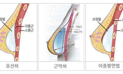 乳腺下・筋膜下・デュアルプレーン法のインプラント挿入位置3種比較断面図