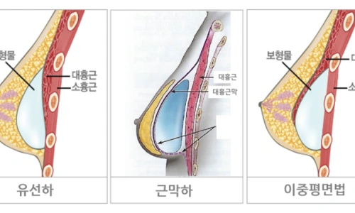 유선하·근막하·이중평면법 보형물 삽입 위치 3종 비교 단면 도해