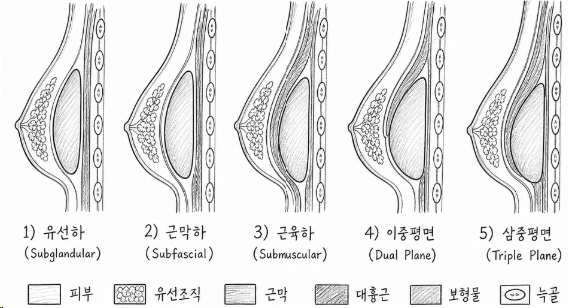 보형물 삽입 평면 5종 비교 단면 일러스트: 유선하·근막하·근육하·이중평면·삼중평면