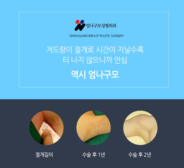 엄나구모 정보글:: 가슴성형마취 걱정없는 엄나구모~~ 안내 이미지