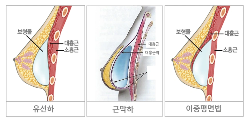 유선하·근막하·이중평면법 보형물 삽입 위치 3종 비교 단면 도해