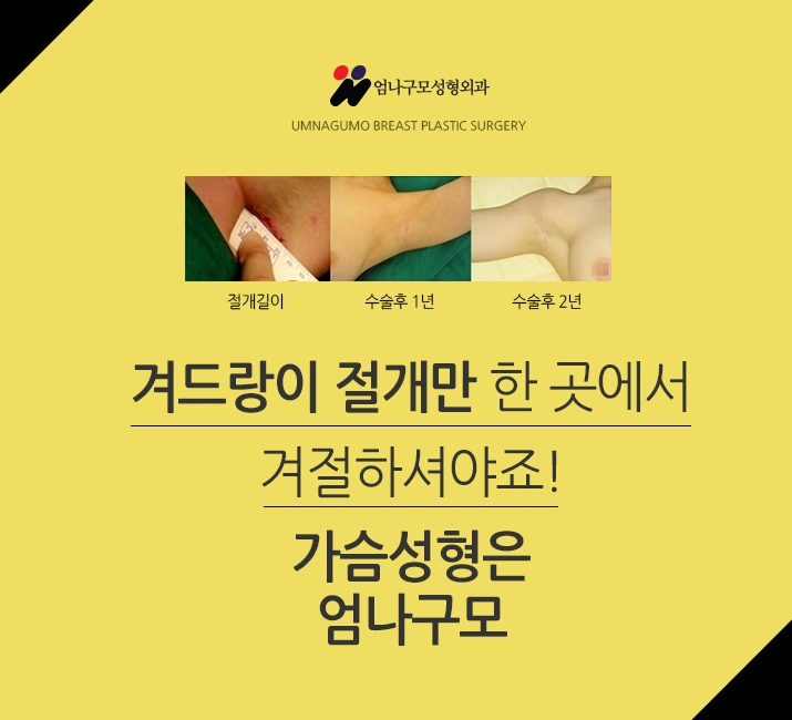 엄나구모 가슴성형>>가슴수술 성공 비결이요??? 안내 이미지