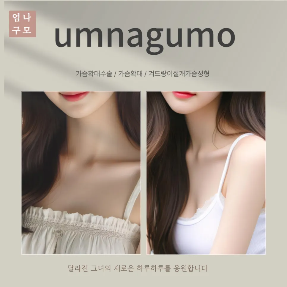 엄나구모성형외과 정보이야기 모티바만 생각하고 계세요? 안내 이미지
