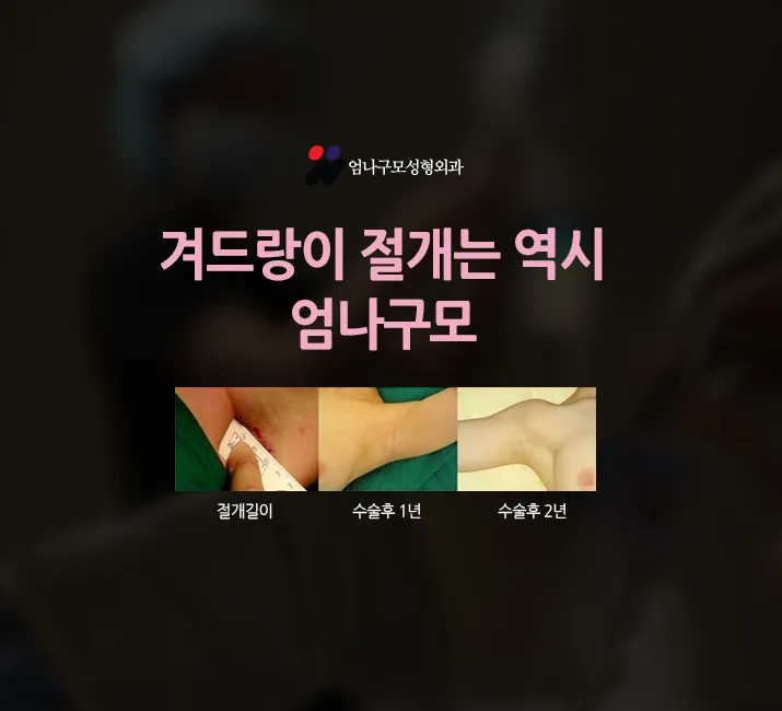 엄나구모 가슴성형 겨드랑이절개인 이유?! 안내 이미지