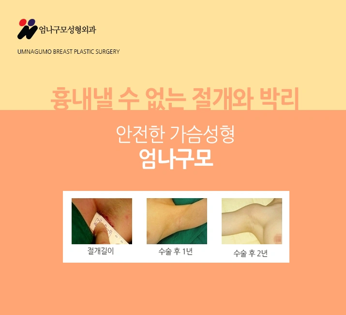 엄나구모 정보글 ※ 가슴성형은 난이도가 있는 만큼 신중하게! 안내 이미지