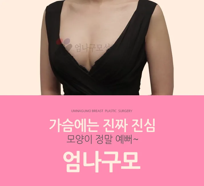 엄나구모 정보글 >>  엄나구모성형외과에서 가슴성형 진행?!~ 안내 이미지