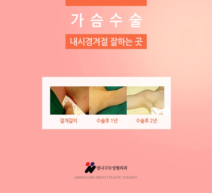 엄나구모 정보글 가슴과 관련된 스트레스는 많은 여성들에게 일어납니다. 안내 이미지