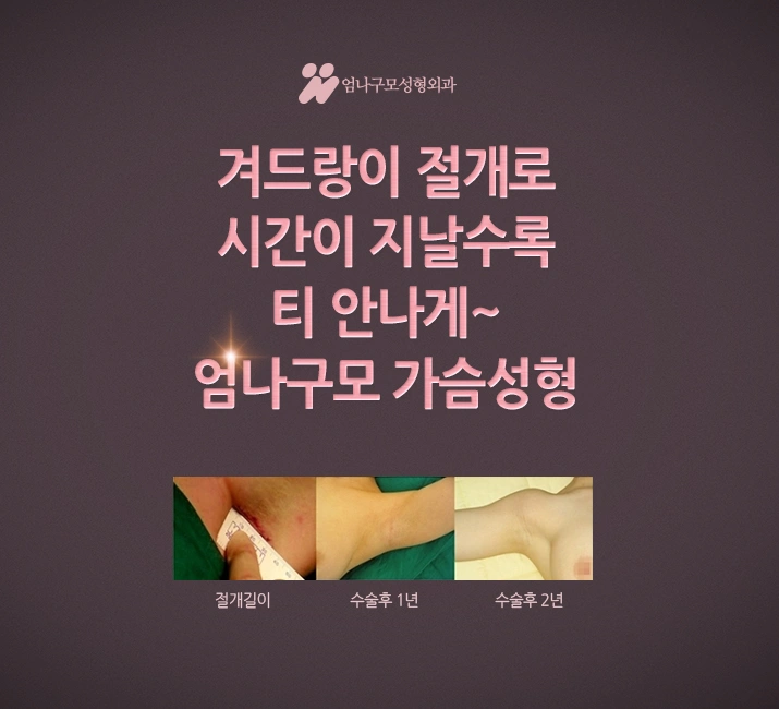 엄나구모정보글 / 가슴성형 자연스러우면서 예쁜볼륨 편 안내 이미지